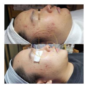 피부 트러블 관리