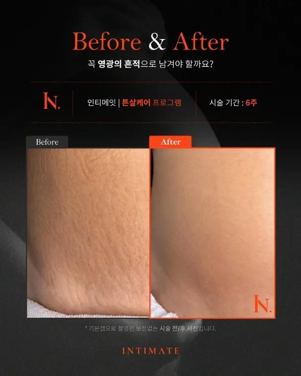 인티메잇 다산왁싱(튼살케어)