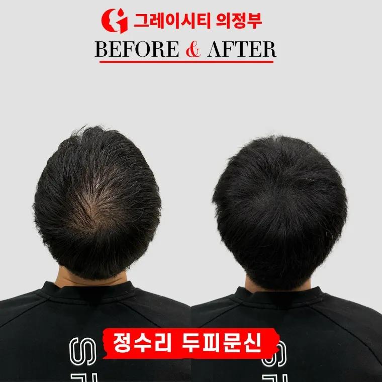 그레이시티두피문신 의정부점