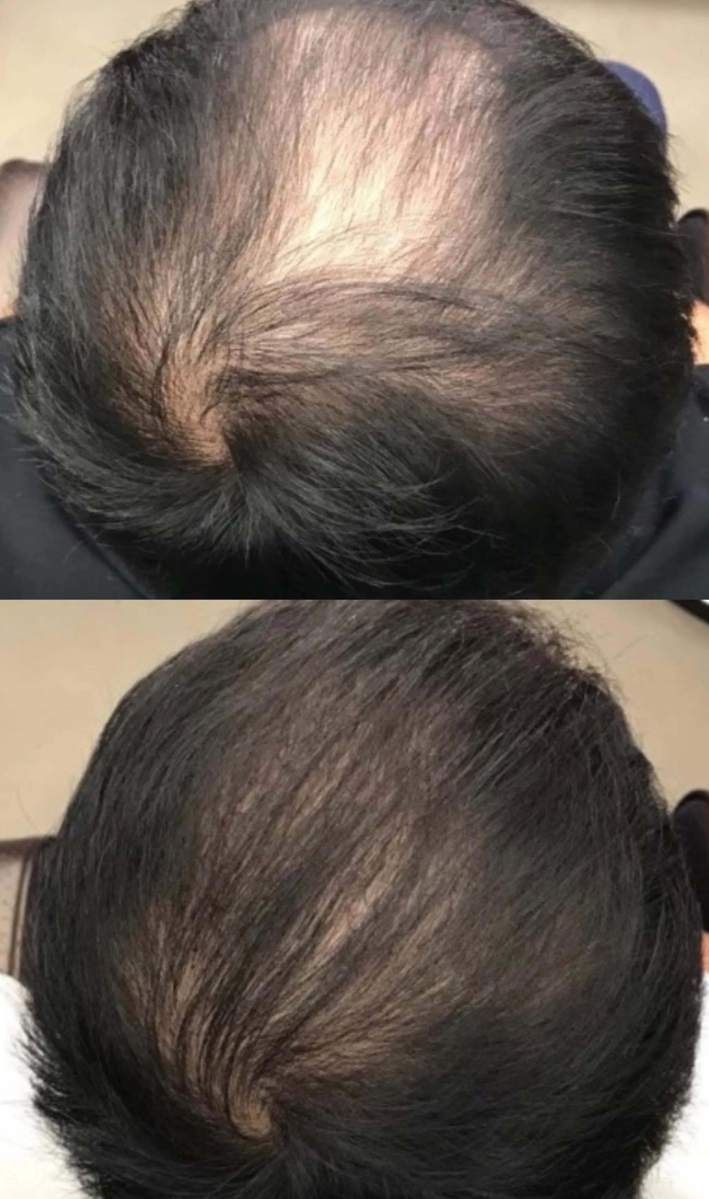 헤어증모술 남성탈모커버