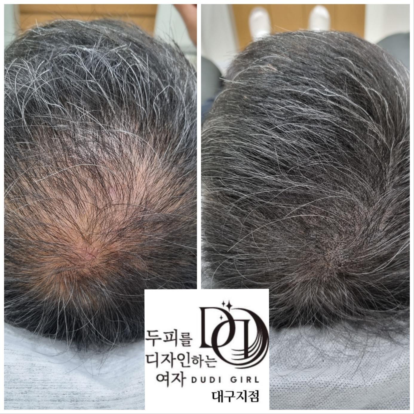두피를 디자인하는 여자 대구점