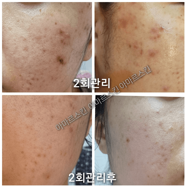 아마르스킨